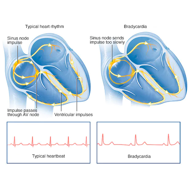 Bradycardia