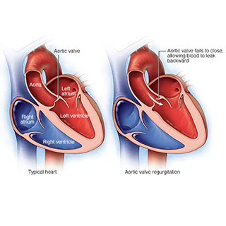 Aortic Valve Regurgitation