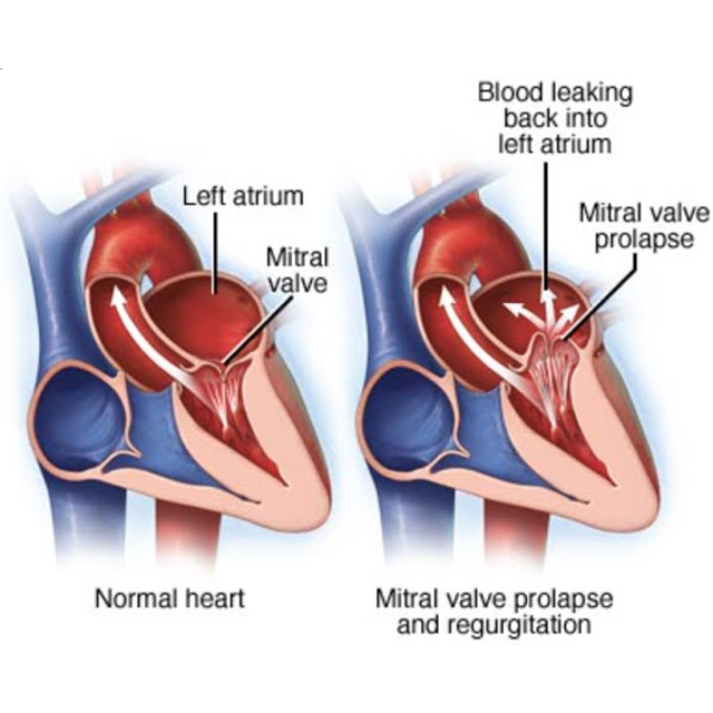 Mitral Valve Collapse