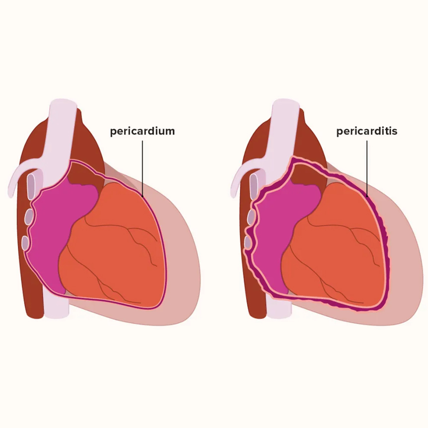 Pericarditis