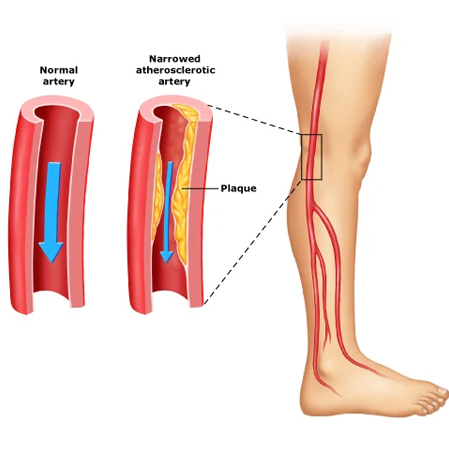 Peripheral Arterial Disease of the Legs