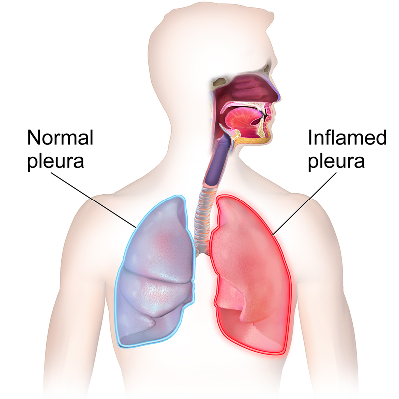 Pleurisy