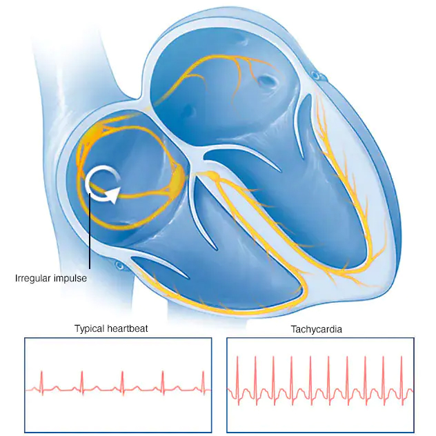 Tachycardia